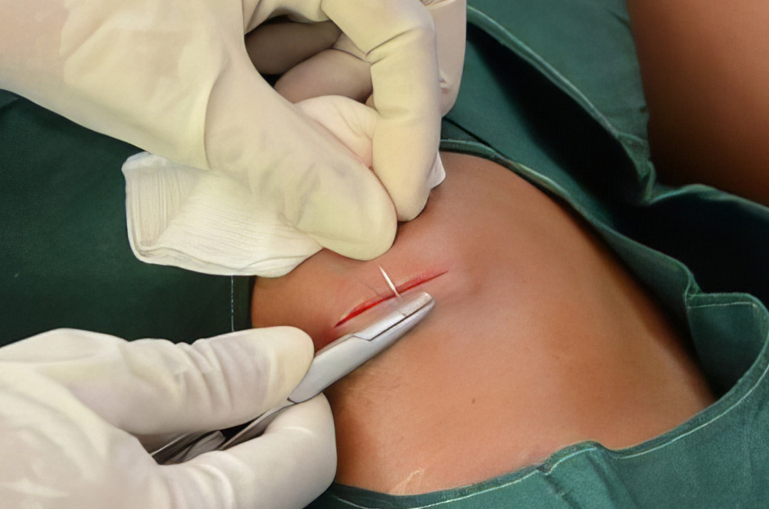 Suturing for Health Professionals Workshop (Mooloolaba, QLD)